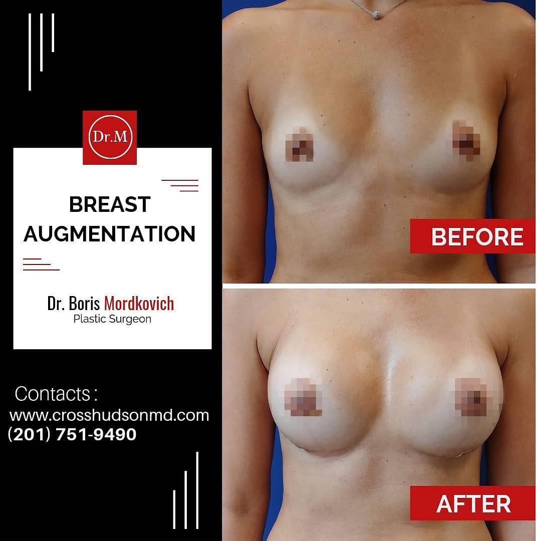 Breast augmentation before and after results by Dr. Boris Mordkovich, plastic surgeon in Fort Lee, NJ